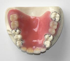 プラスチック義歯